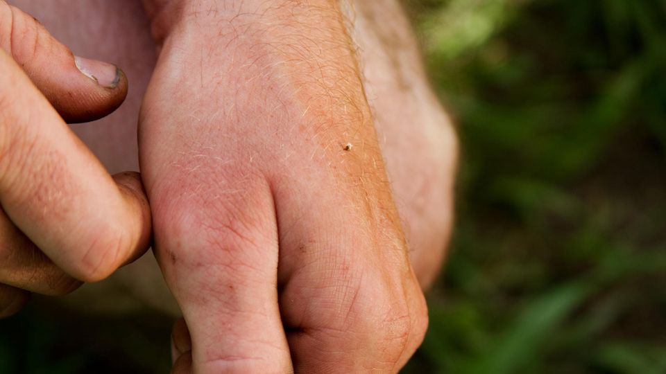 Bienenstich: Stacheln in der Hand